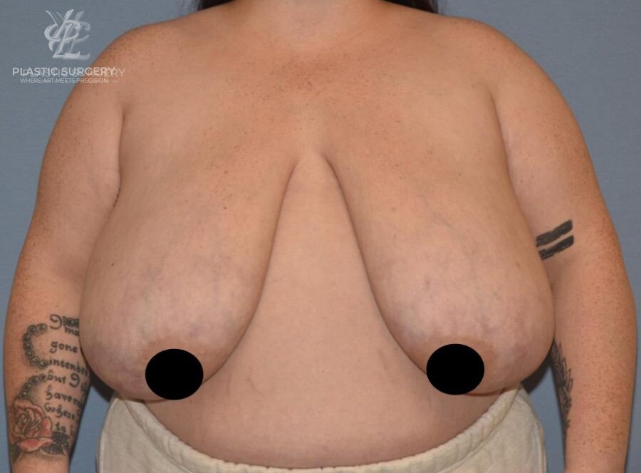 Breast Reduction, patient 22, before, view 1