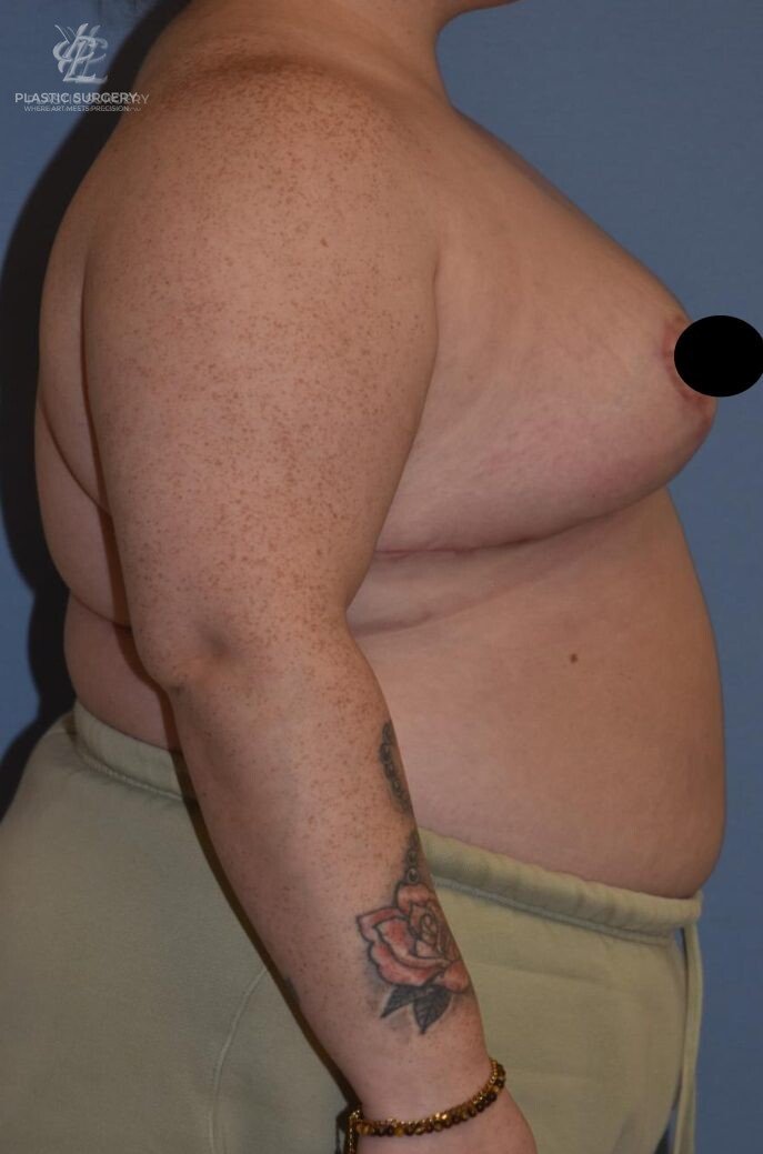Breast Reduction, patient 22, after, view 3