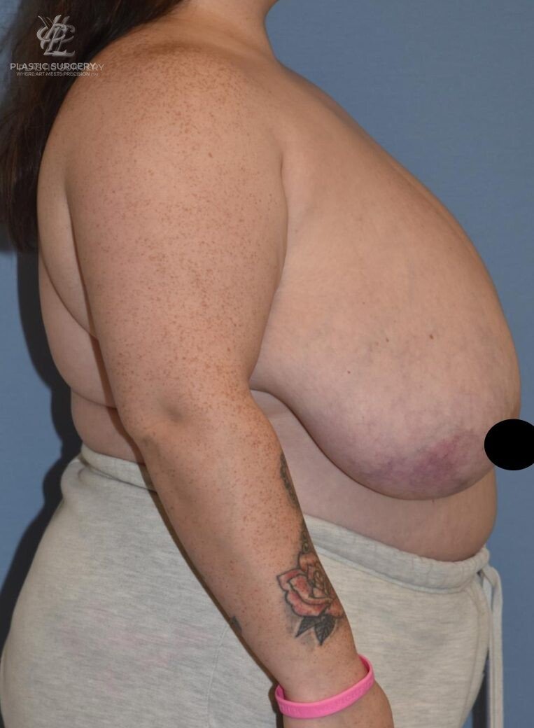 Breast Reduction, patient 22, before, view 3
