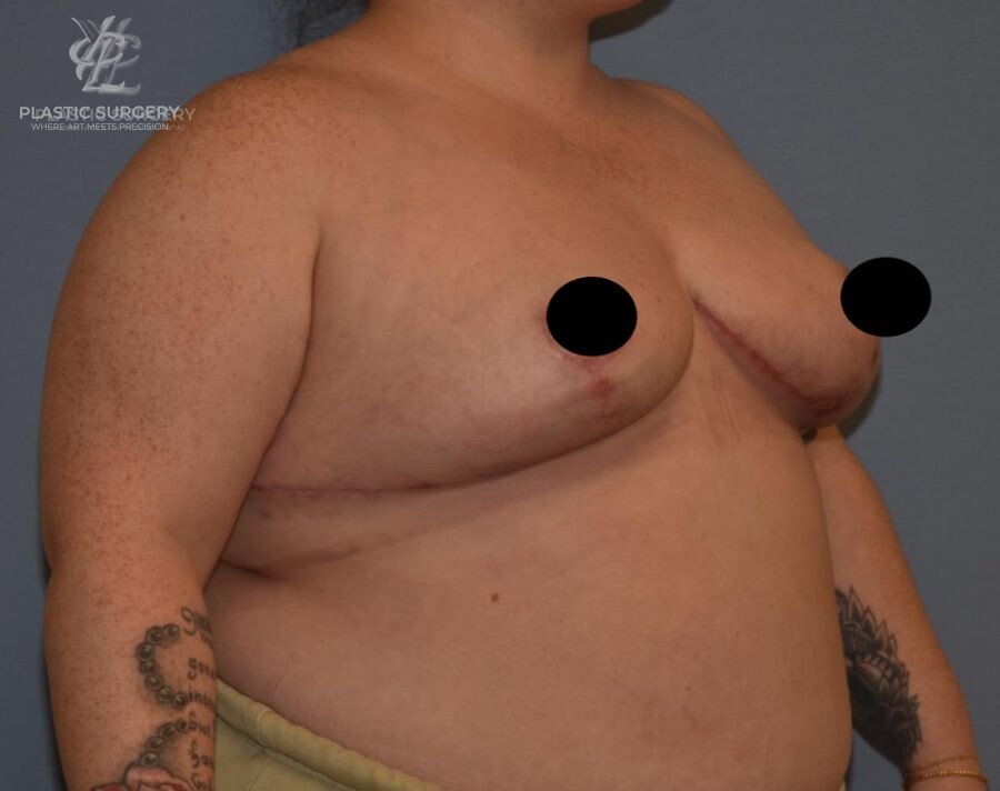 Breast Reduction, patient 22, after, view 2