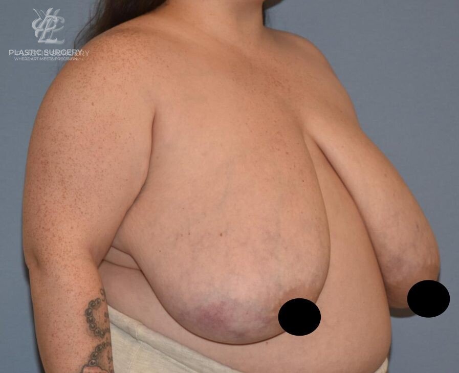 Breast Reduction, patient 22, before, view 2