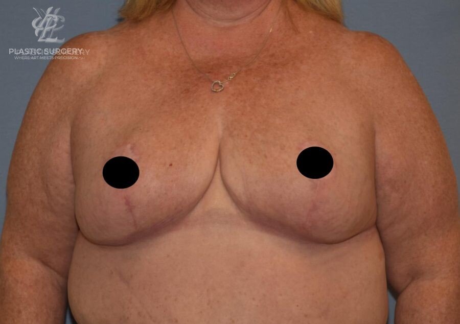 Breast Reduction, patient 23, after, view 1
