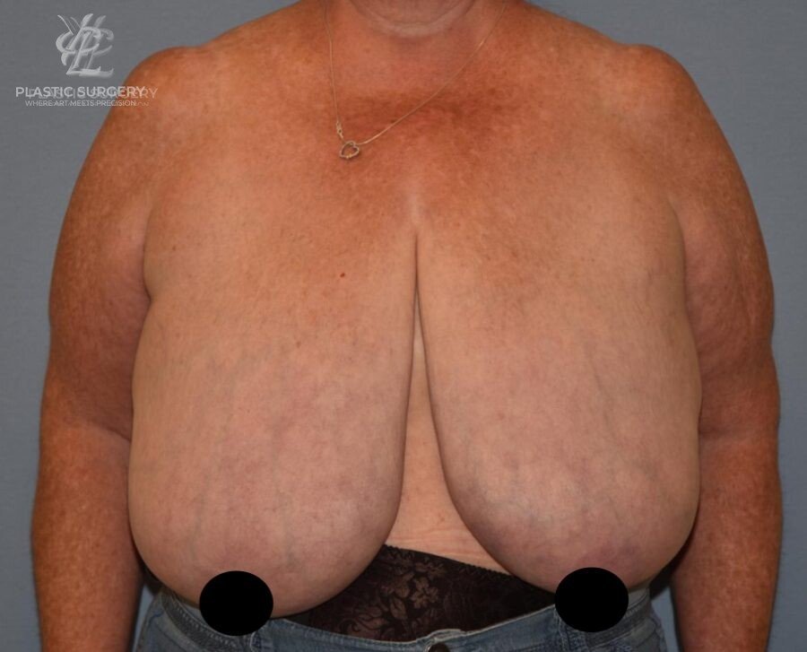 Breast Reduction, patient 23, before, view 1