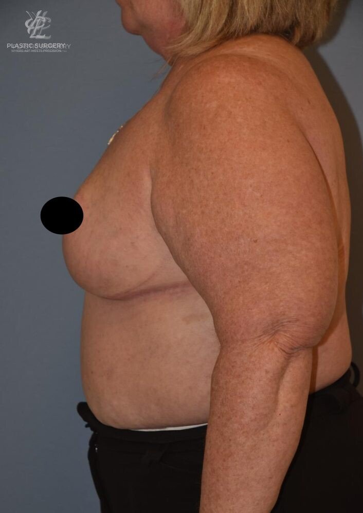 Breast Reduction, patient 23, after, view 3