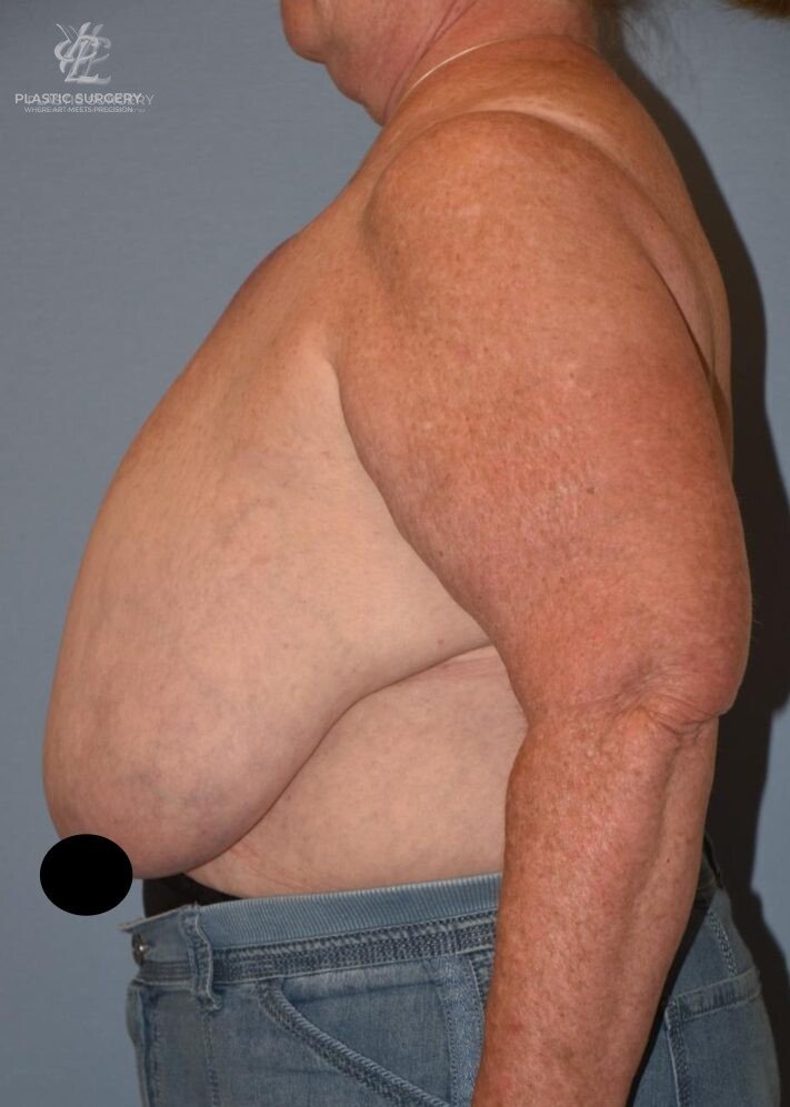 Breast Reduction, patient 23, before, view 3