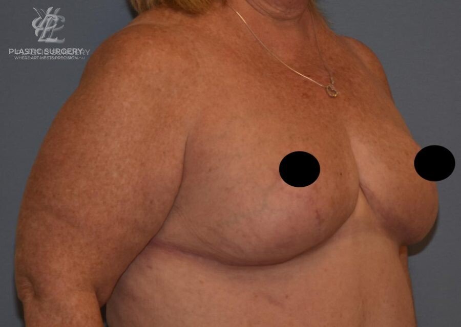Breast Reduction, patient 23, after, view 2