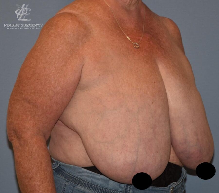 Breast Reduction, patient 23, before, view 2