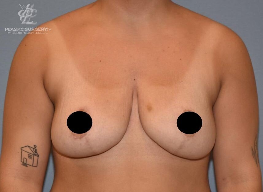 Breast Reduction, patient 24, after, view 1