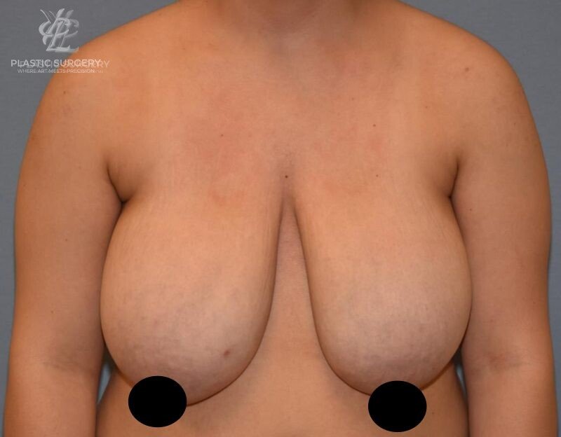 Breast Reduction, patient 24, before, view 1