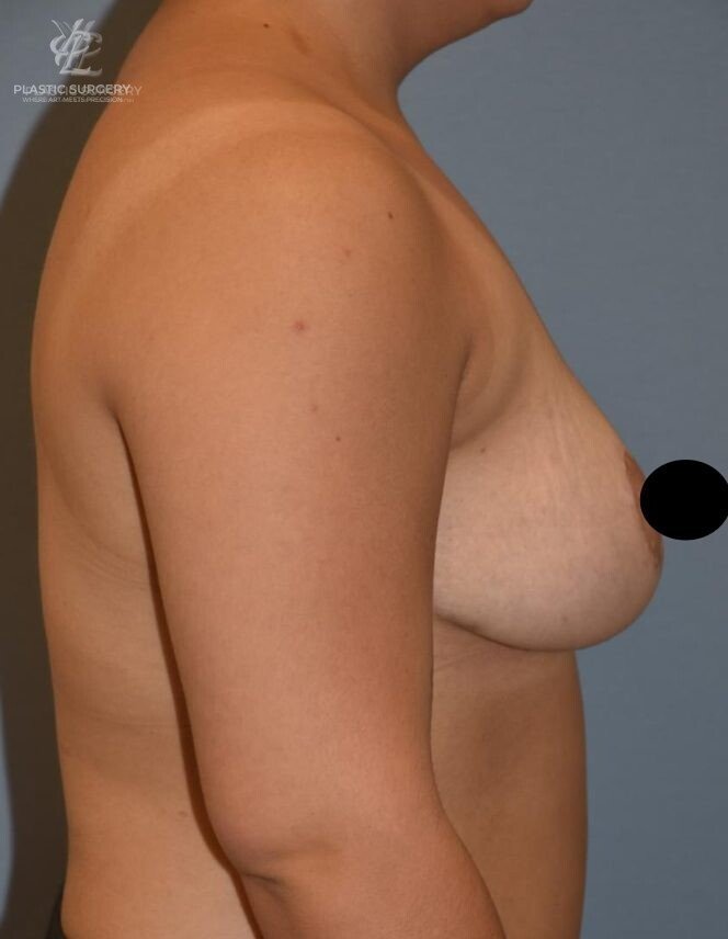 Breast Reduction, patient 24, after, view 3