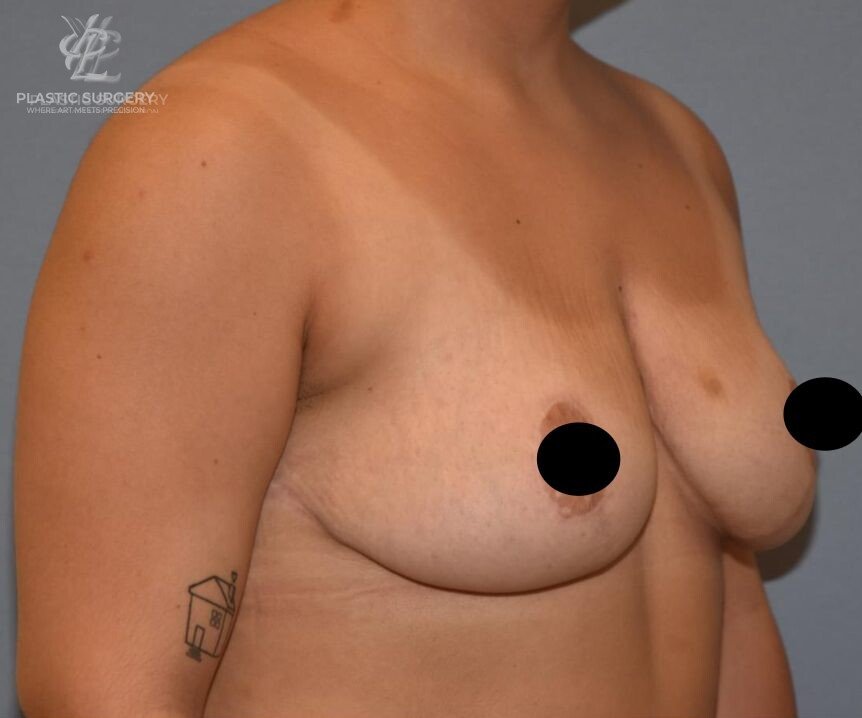 Breast Reduction, patient 24, after, view 2