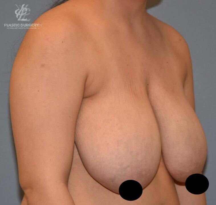 Breast Reduction, patient 24, before, view 2