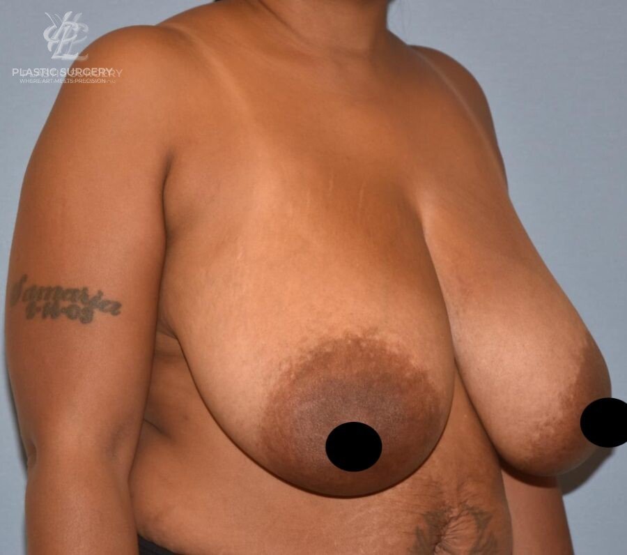 Breast Reduction, patient 25, before, view 2