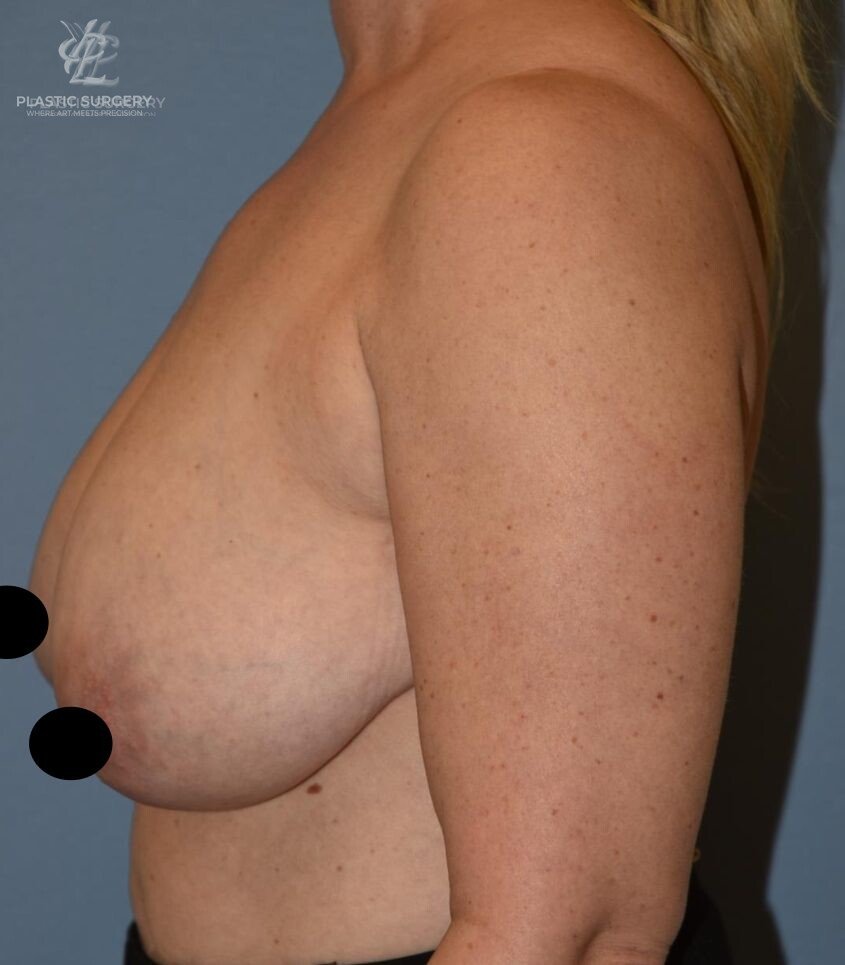 Breast Reduction, patient 27, before, view 3