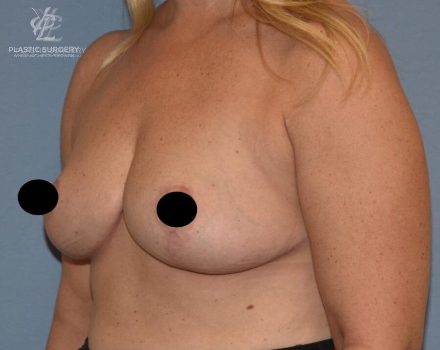 Breast Reduction, patient 27, after, view 2