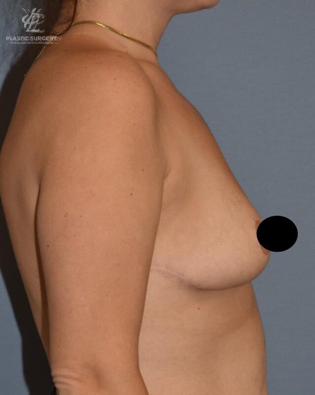 Breast Reduction, patient 28, after, view 3
