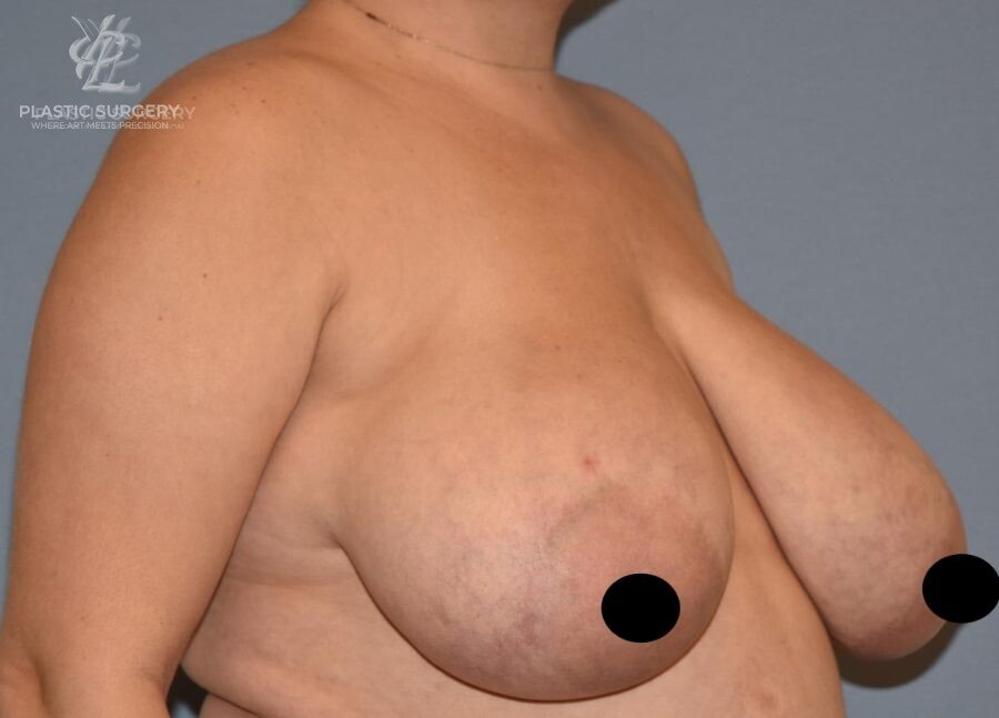 Breast Reduction, patient 28, before, view 2