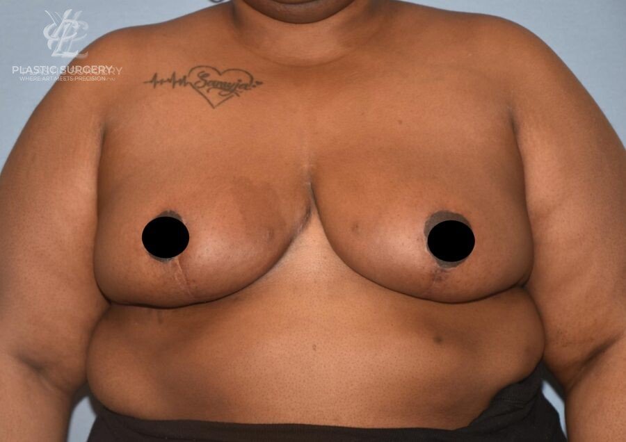 Breast Reduction, patient 29, after, view 1
