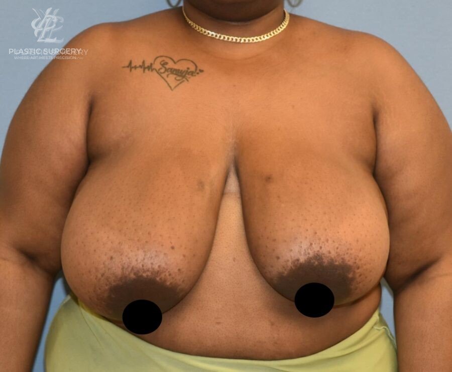 Breast Reduction, patient 29, before, view 1