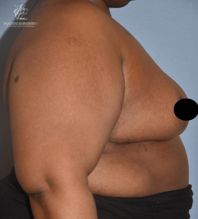 Breast Reduction, patient 29, after, view 3