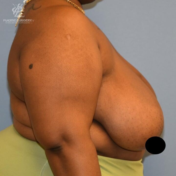 Breast Reduction, patient 29, before, view 3