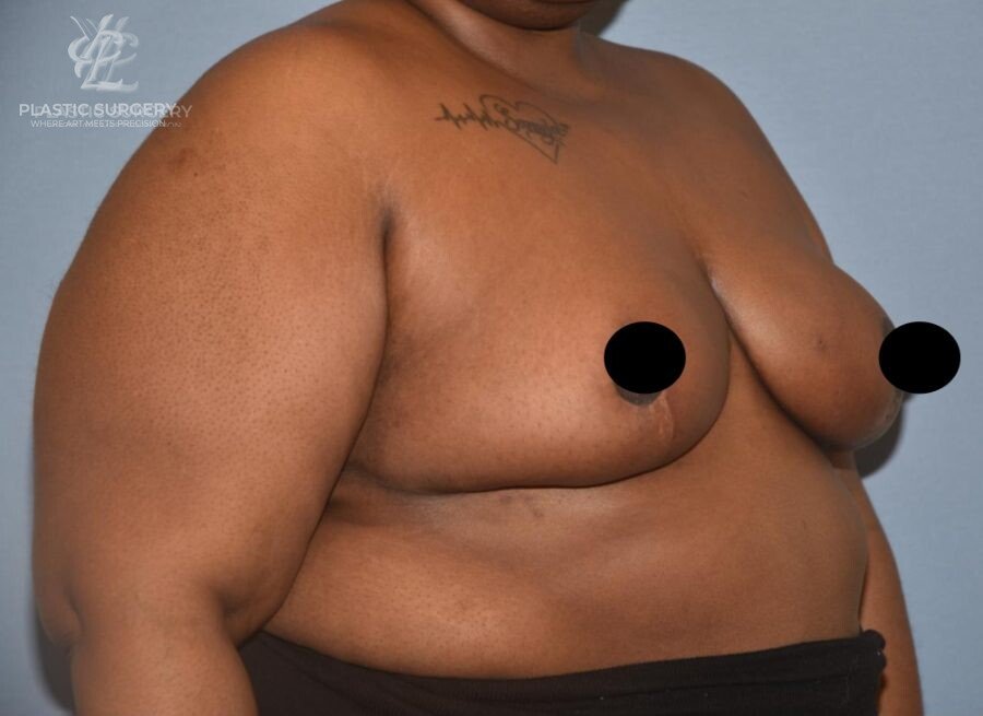 Breast Reduction, patient 29, after, view 2