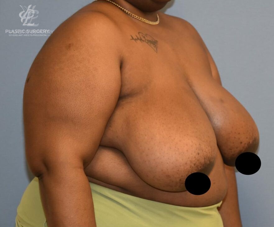 Breast Reduction, patient 29, before, view 2