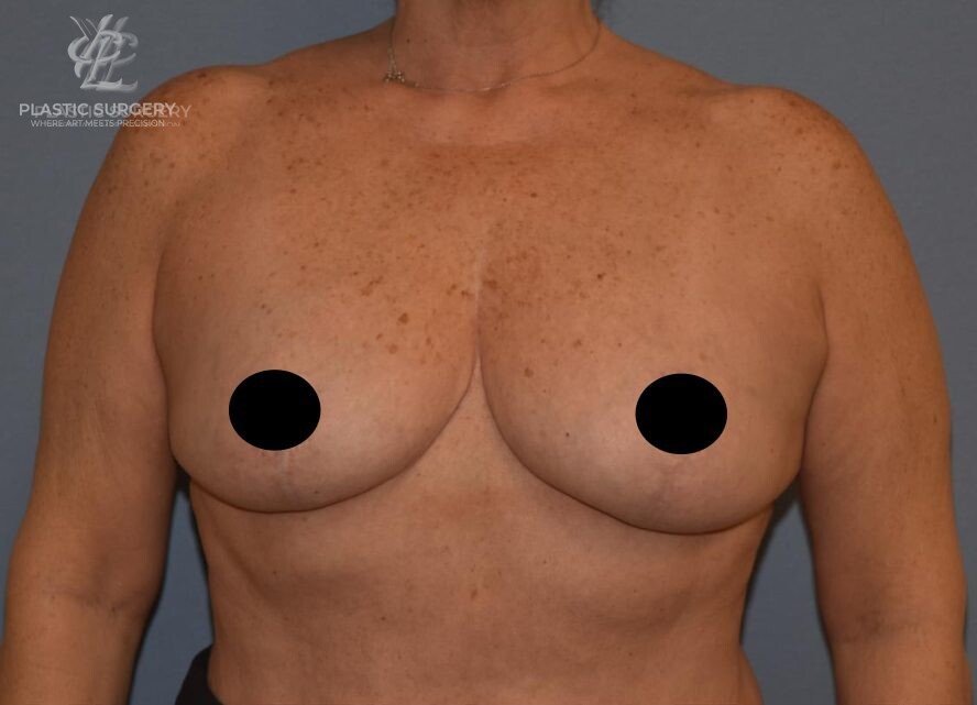 Breast Reduction, patient 30, after, view 1