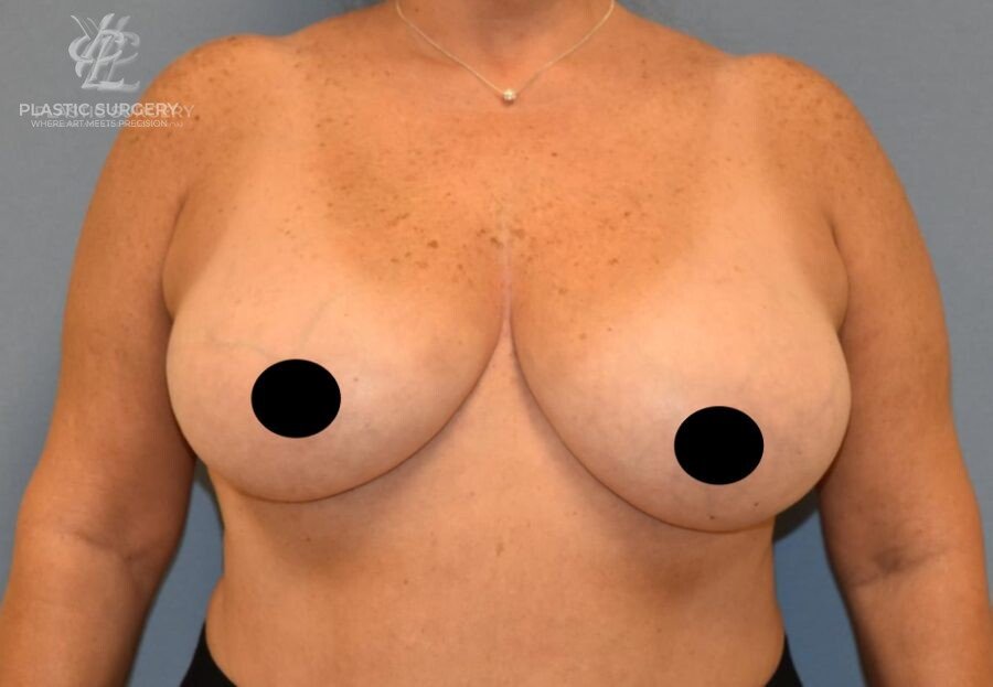 Breast Reduction, patient 30, before, view 1