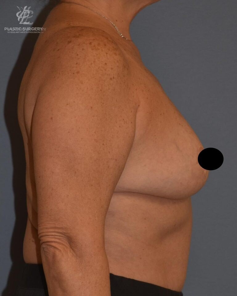 Breast Reduction, patient 30, after, view 3