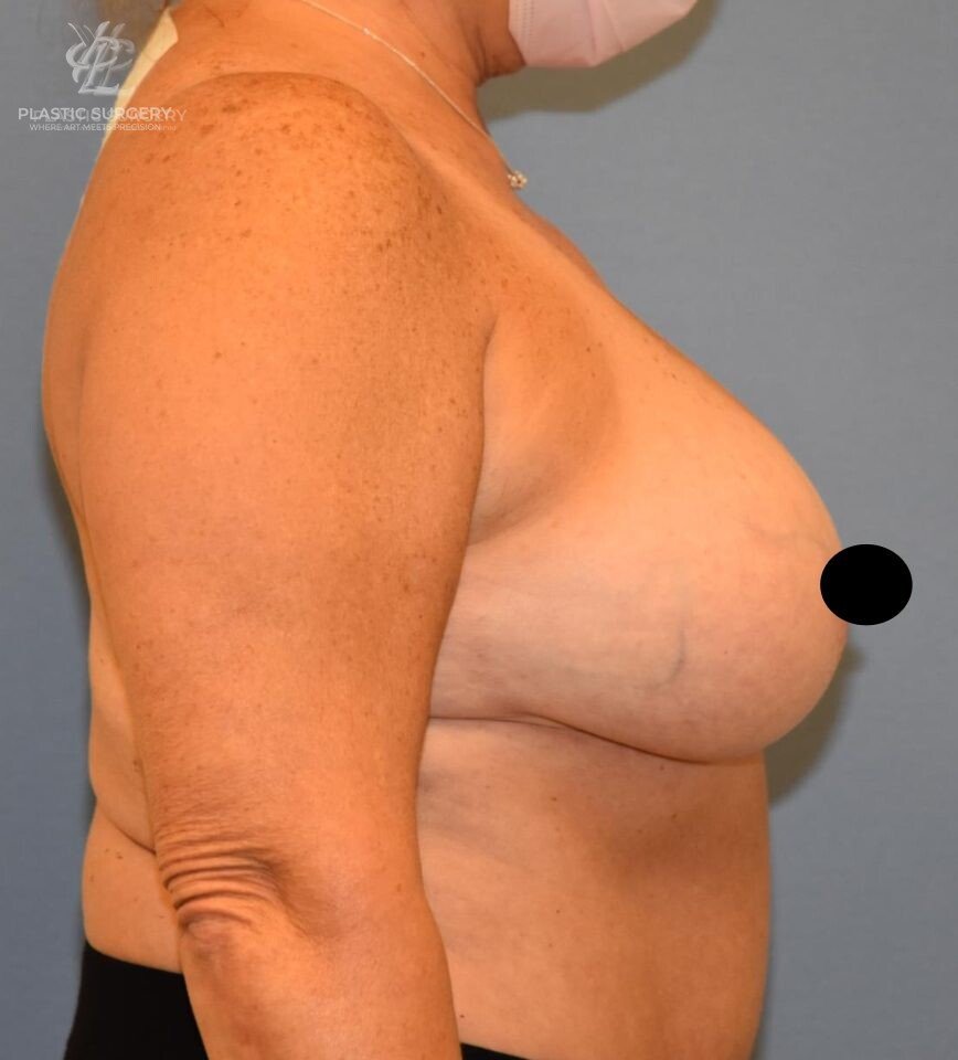 Breast Reduction, patient 30, before, view 3