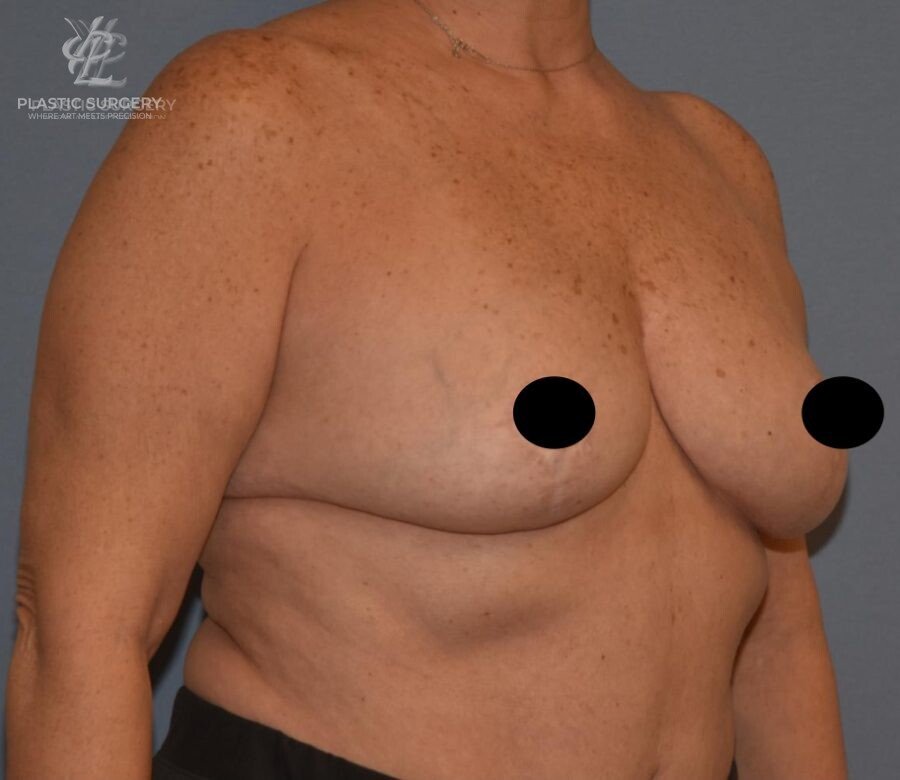 Breast Reduction, patient 30, after, view 2