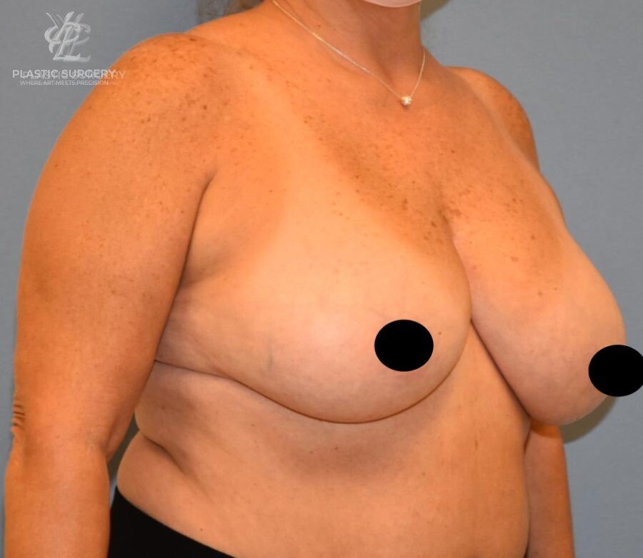 Breast Reduction, patient 30, before, view 2