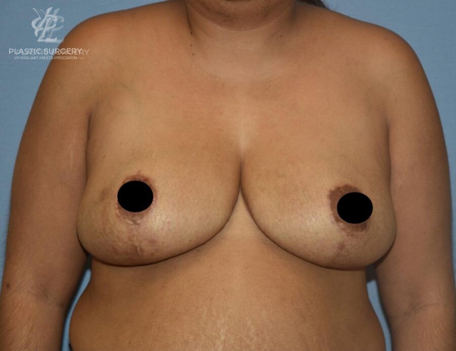 Breast Reduction, patient 31, after, view 1