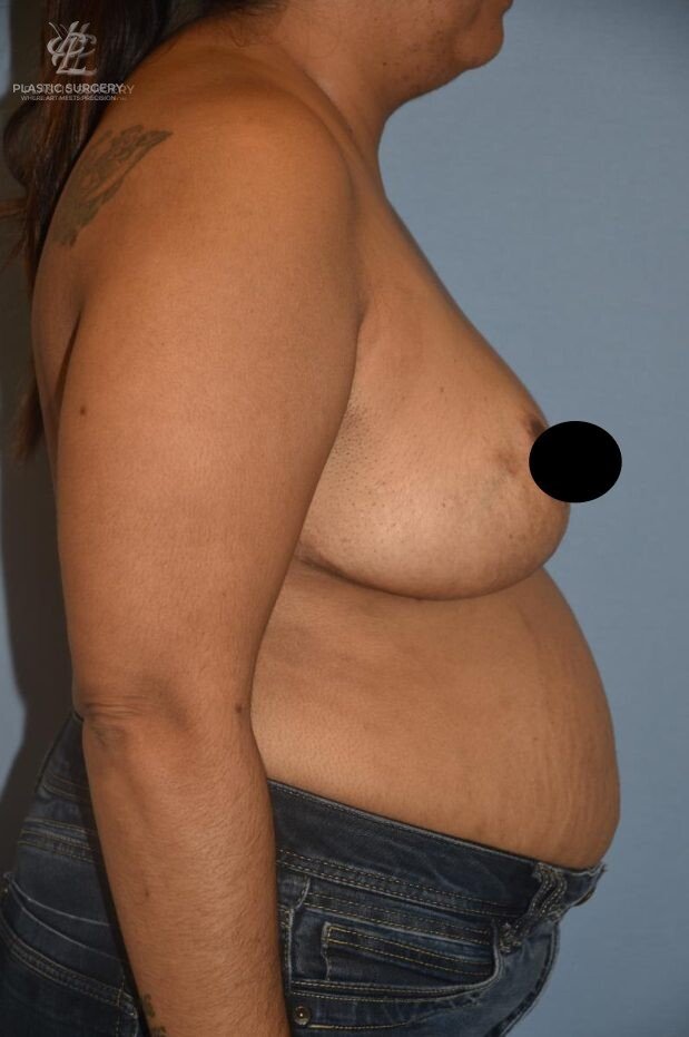 Breast Reduction, patient 31, after, view 3
