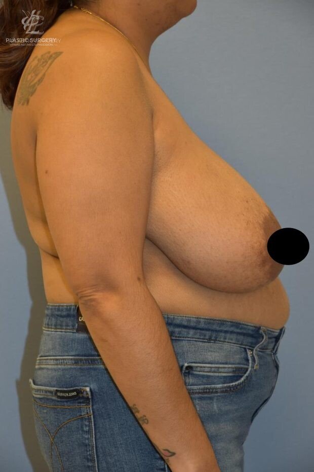 Breast Reduction, patient 31, before, view 3