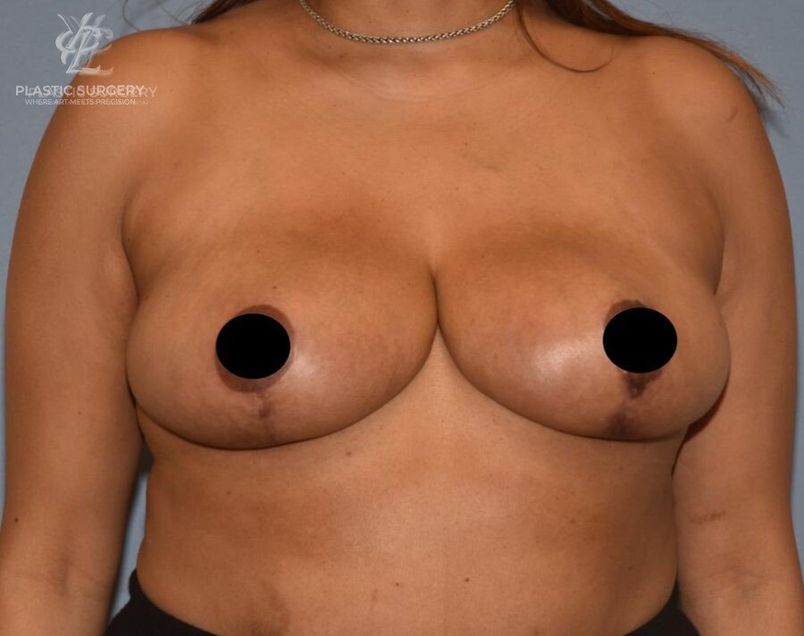 Breast Reduction, patient 32, after, view 1