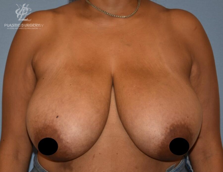 Breast Reduction, patient 32, before, view 1
