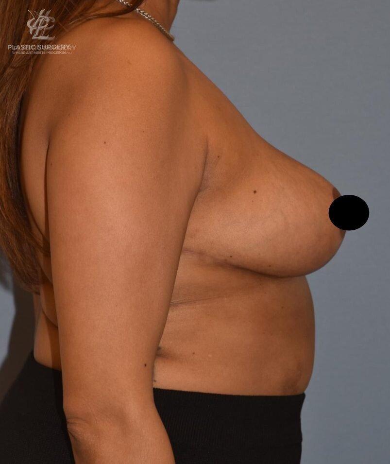 Breast Reduction, patient 32, after, view 3