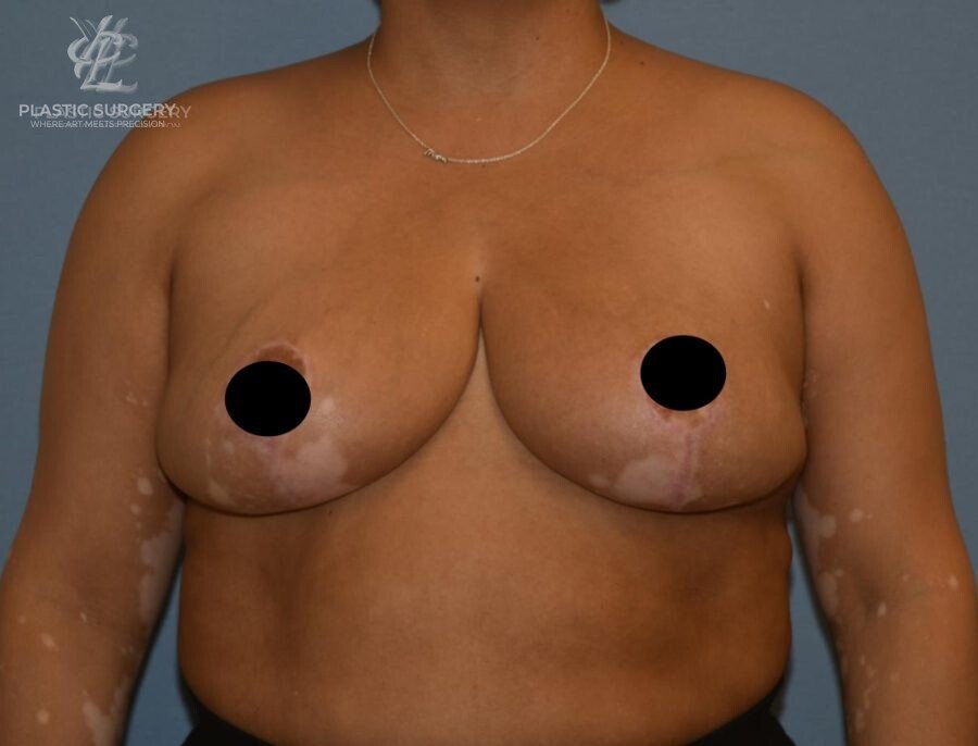 Breast Reduction, patient 33, after, view 1