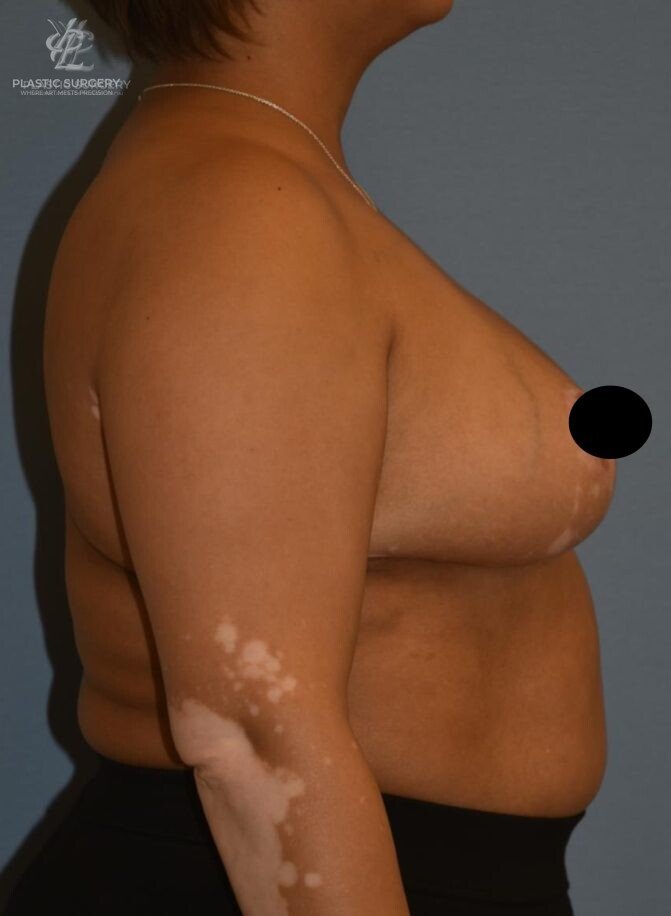 Breast Reduction, patient 33, after, view 3