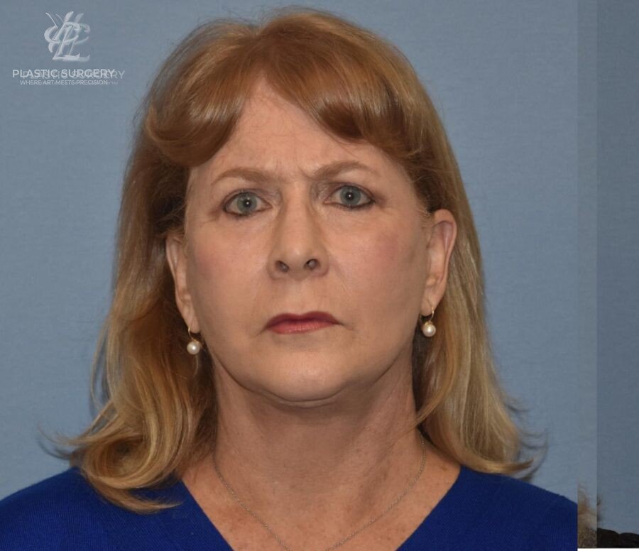 Face & Neck Lift, patient 1, after, view 1