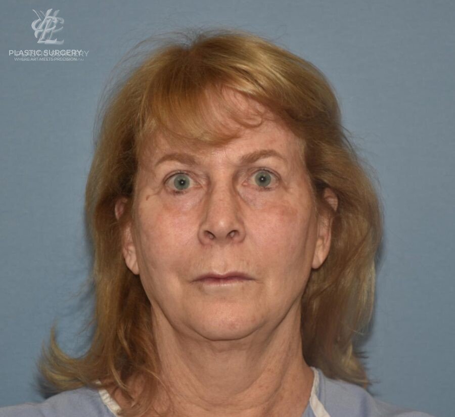 Face & Neck Lift, patient 1, before, view 1