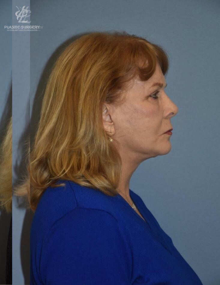 Face & Neck Lift, patient 1, after, view 3