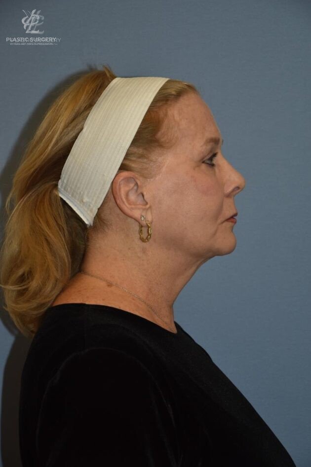 Face & Neck Lift, patient 1, before, view 3