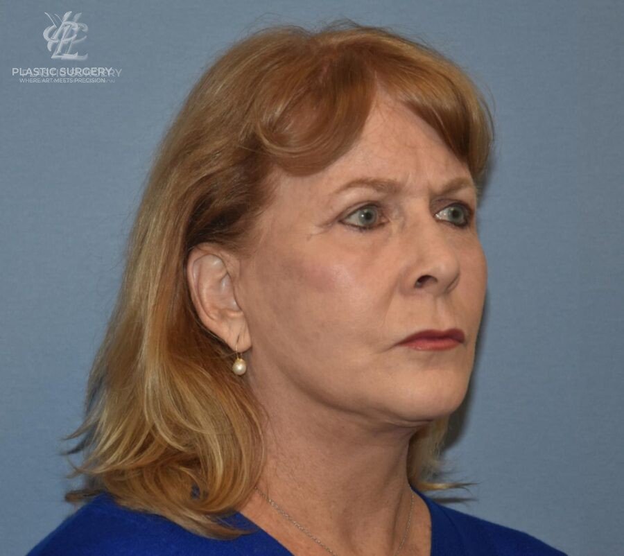 Face & Neck Lift, patient 1, after, view 2