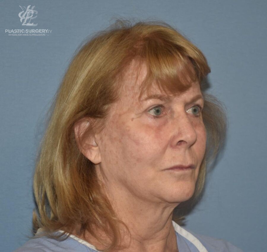 Face & Neck Lift, patient 1, before, view 2