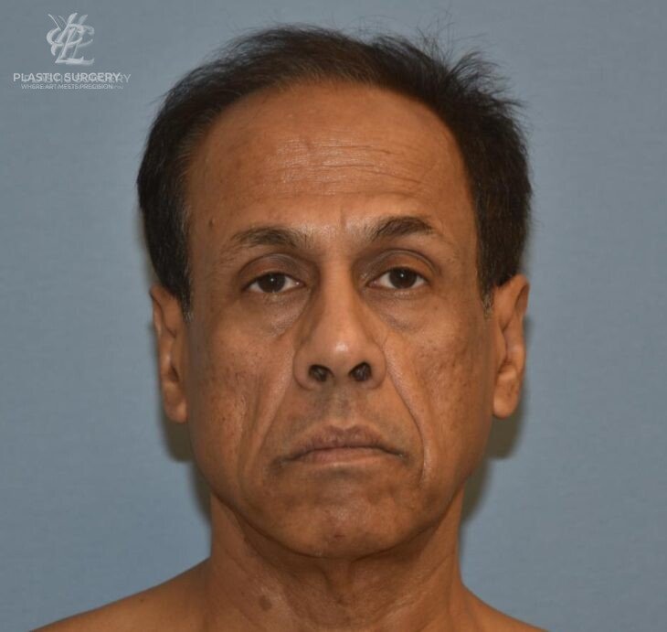 Facial Fat Grafting, patient 1, before, view 1