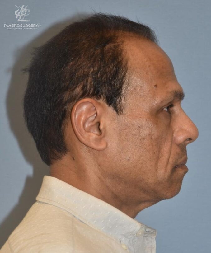 Facial Fat Grafting, patient 1, after, view 3
