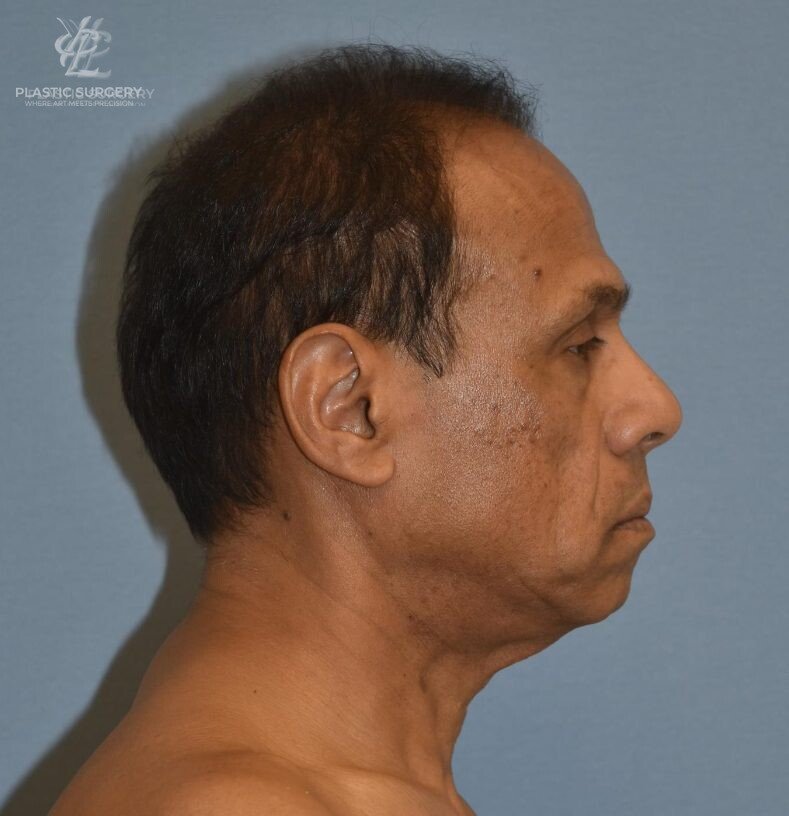 Facial Fat Grafting, patient 1, before, view 3